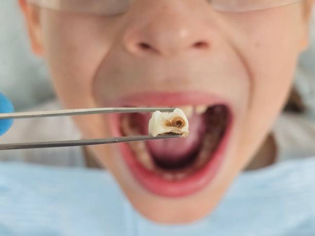 Best Emergency Tooth Extraction in Prairie Ridge, WA